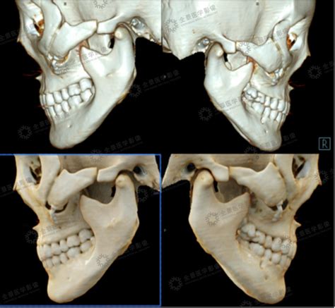 多层螺旋 Ct 三维重建在鼻骨、下颌骨整形中的应用 － 丁香园
