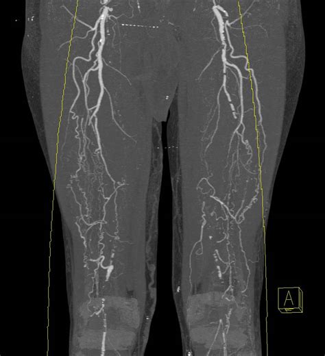 Runoff Using Dual Energy With Bone And Calcium Removal Shows Extensive