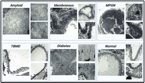 Electron Microscopy Images And The Spectrum Of Medical Kidney Disease