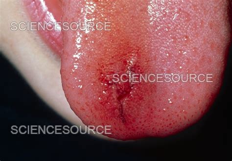 Bitten tongue | Stock Image - Science Source Images