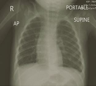 Resolution of chylous effusion. | Download Scientific Diagram