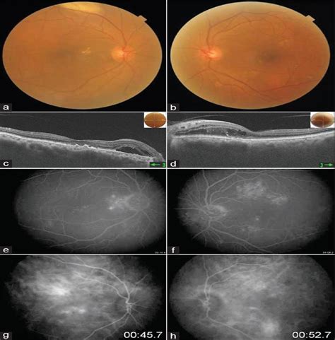 Bilateral Diffuse Uveal Melanocytic Proliferation Secondary Indian