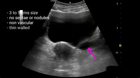 Simple Or Functional Cyst Of Ovary Ultrasound Video Youtube