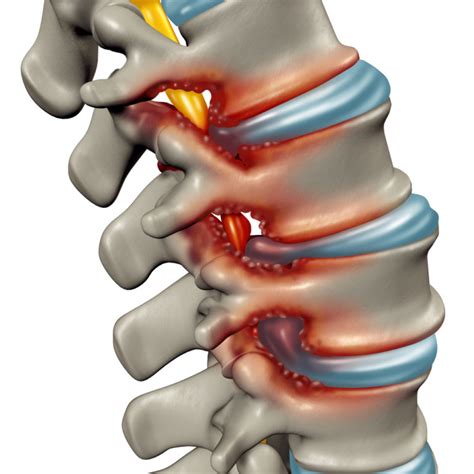 Spinal Canal Stenosis in the Lumbar Spine - Chiropractic Perth ...