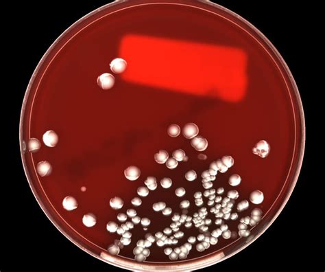 How To Read Your Blood Culture Report Mypathologyreportca