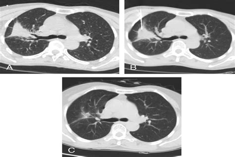 Diagnostic Yield Of Computed Tomography Guided Percutaneous