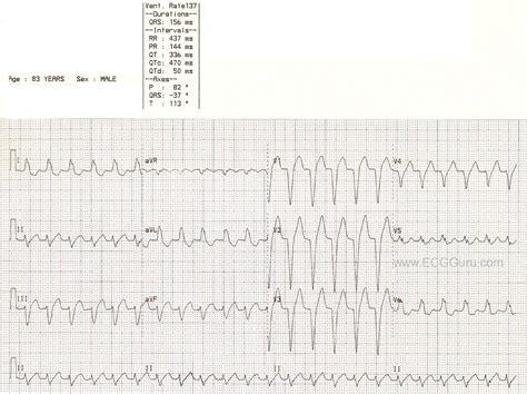 Wide Complex Tachycardia Ecg Guru Instructor Resources