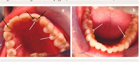 Figure From Dens Invaginatus And Dens Evaginatus In A Single Tooth