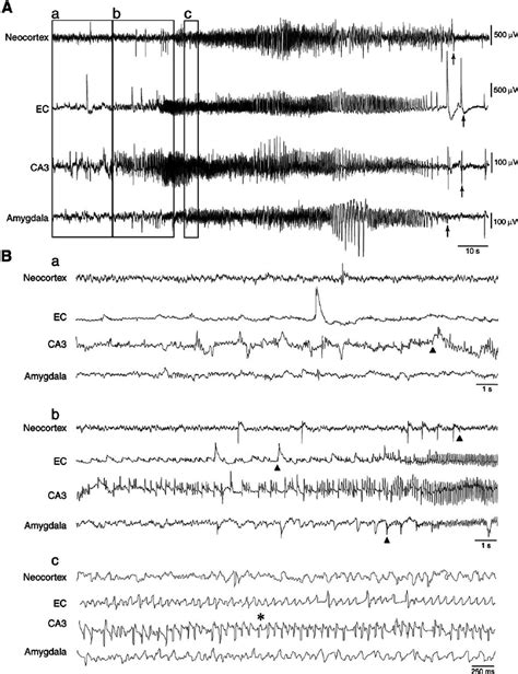 A Spontaneous Non Convulsive Seizure Stage 2 Of Racines Scale After