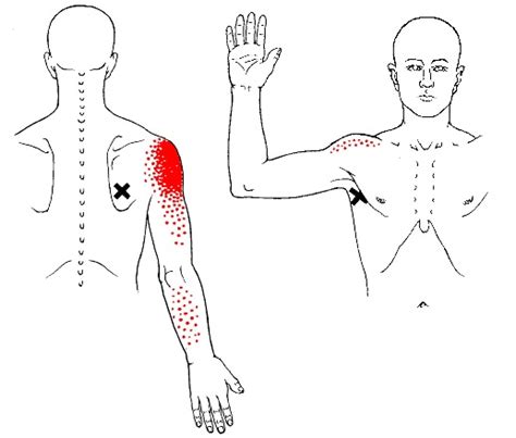 Teres Major Trigger Points And Referred Pain Trigger Point Self Help