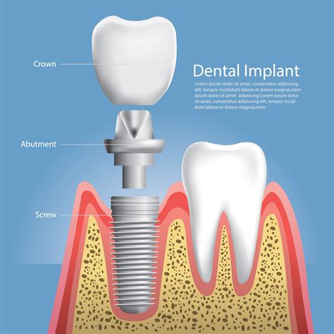 Human Teeth And Dental Implant Vector Illustration Vector Art At