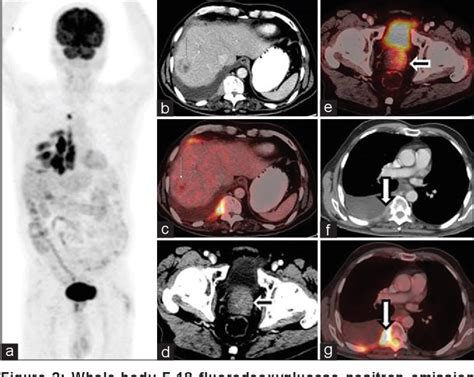 Figure From A Rare Case Of Liver Metastasis From Prostate Cancer