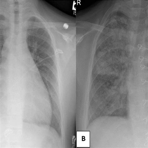 Postero Anterior Chest Radiograph A Pretransplant Image Showing