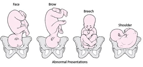 Fetal Positions For Labor And Birth