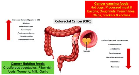 The Pivotal Role Of The Gut Microbiome In Colorectal Cancer