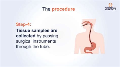 Endoscopy: Types, Preparation, Diagnosis, Procedure and Risks | PPT