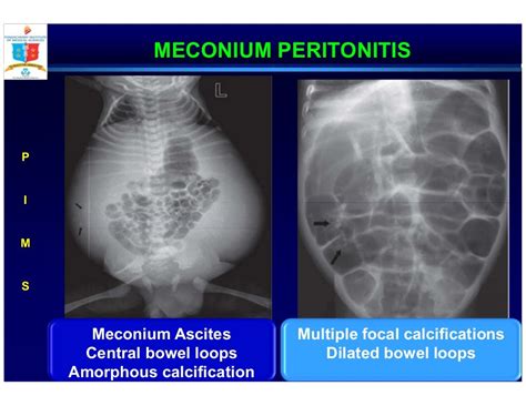 Neonatal Biliary Emesis A Problem Based Approach