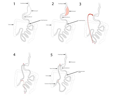 Bariatric Procedures Bariatric Surgery Education