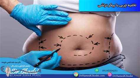 برسی جامع عمل پیکر تراشی شکم و پهلو روش‌های پیکرتراشی شکم و پهلو