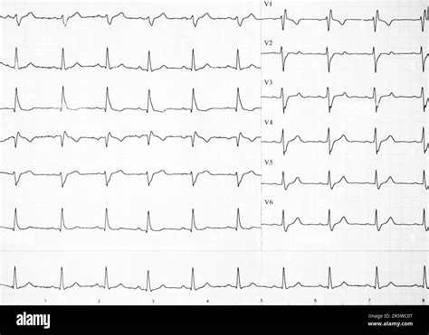 Atrial Flutter Ecg Strip