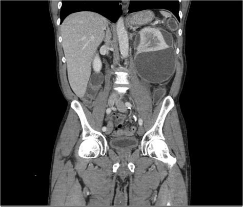 Coronal Plane Image Of Pancreatic Cyst Formation With Left Renal