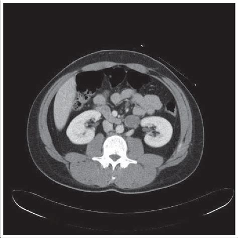 Ct Scan Demonstrating 28 Cm Left Hilar Lymph Node Download Scientific Diagram