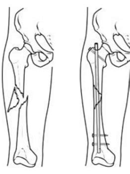 Lower Extremity Fracture Surgery Jason H Tam M D