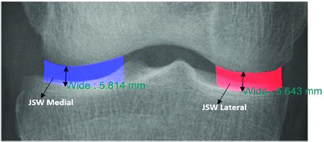 Automatic Measurements Of Joint Space Width Jsw Medial And Lateral