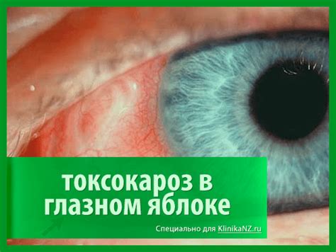 Токсокароз: что это, причины, опасность, диагностика, лечение