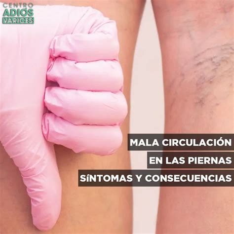 Mala Circulación En Las Piernas】 Causas Y Prevención