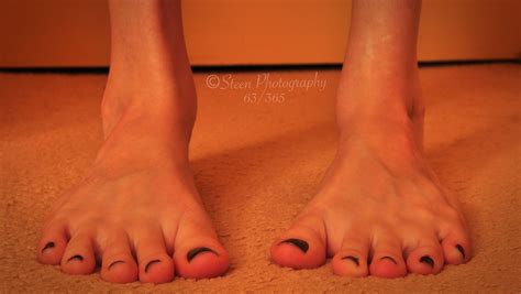 63 365 Club Feet These Are My Feet I Was Born With 2 Seve… Flickr