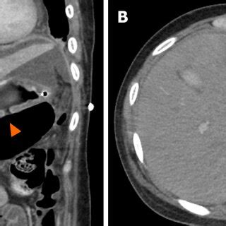 Follow Up Computed Tomography Scan On Rd Postoperative Day A And B