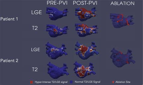 Visualization Of Acute Edema In The Left Atrial Myocardium After