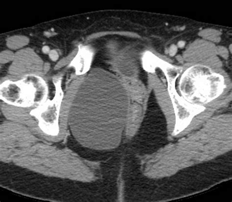 Perirectal Cyst