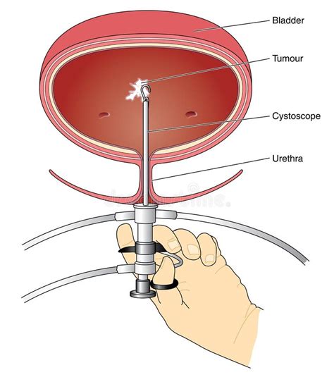 Cystoscopy of bladder stock vector. Illustration of medical - 48434292