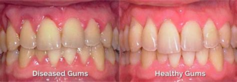 Claremont Dentistry Periodontal Treatment Nicholas Gih Dds