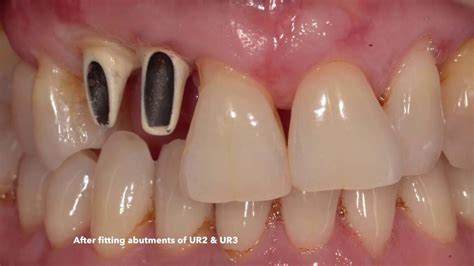 Dental Implant For Upper Incisor And Canine Youtube