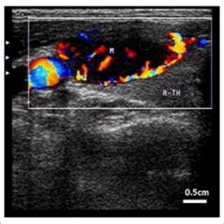 Risk Factors Of Intracystic Hemorrhage With Cystic Thyroid Nodules N