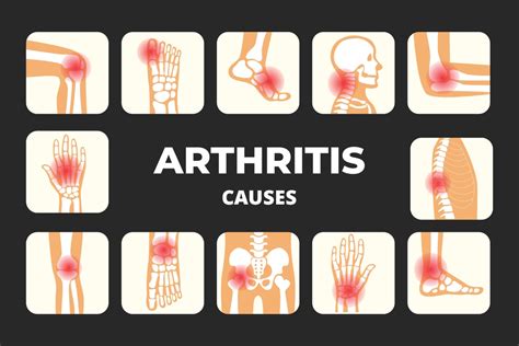 ARTHRITIS (Causes, Symptoms & Treatment) - Forever Champion Health Centre