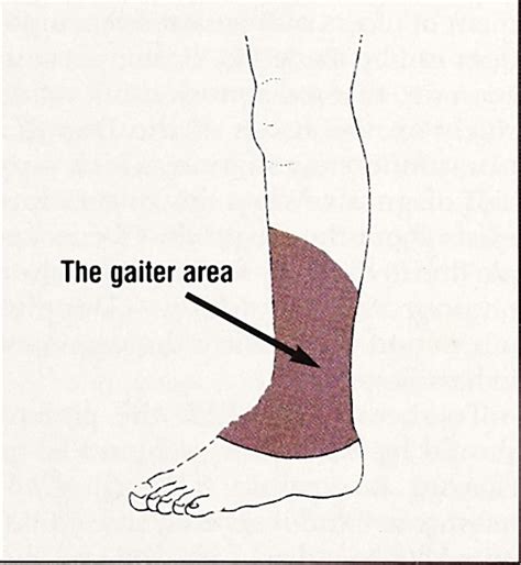 Whats New Management Of Venous Leg Ulcers Approach To 58 Off