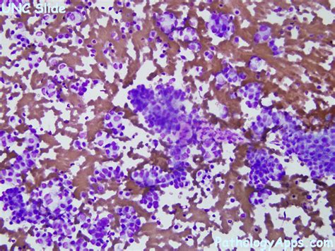 rcc kidney cytology