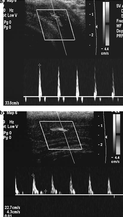 Cavernosal Artery Peak Systolic Velocity Psv Peak Systolic Velocity Download Scientific