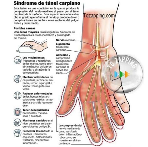 Síndrome Del Túnel Carpiano Túnel carpiano Síndrome del túnel