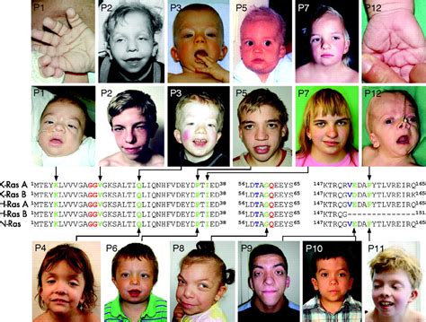 Expansion Of The Genotypic And Phenotypic Spectrum In Patients With