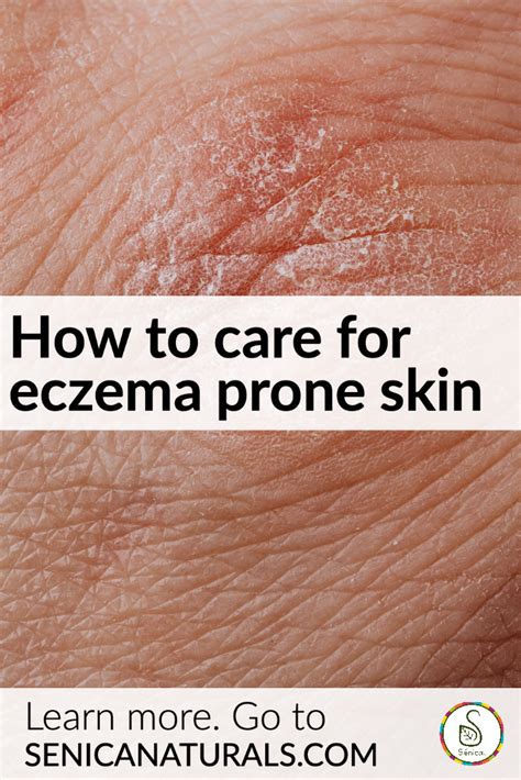 How To Care For Eczema Prone Skin Sénica