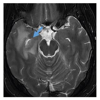 Axial T Weighted A Axial Flair B And Sagittal Flair C Views Of