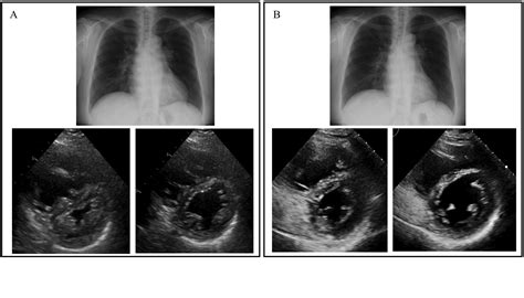 Safe And Successful Transition From Oral Selexipag To Subcutaneous