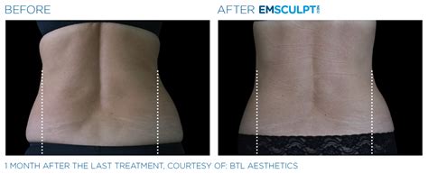 Before And After Emsculpt Neo Aesthetics Wellness