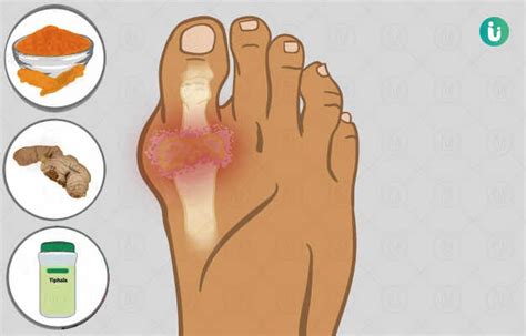 Ayurvedic Medicine And Treatment For Gout