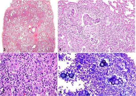 Coccidioidomycosis Histology